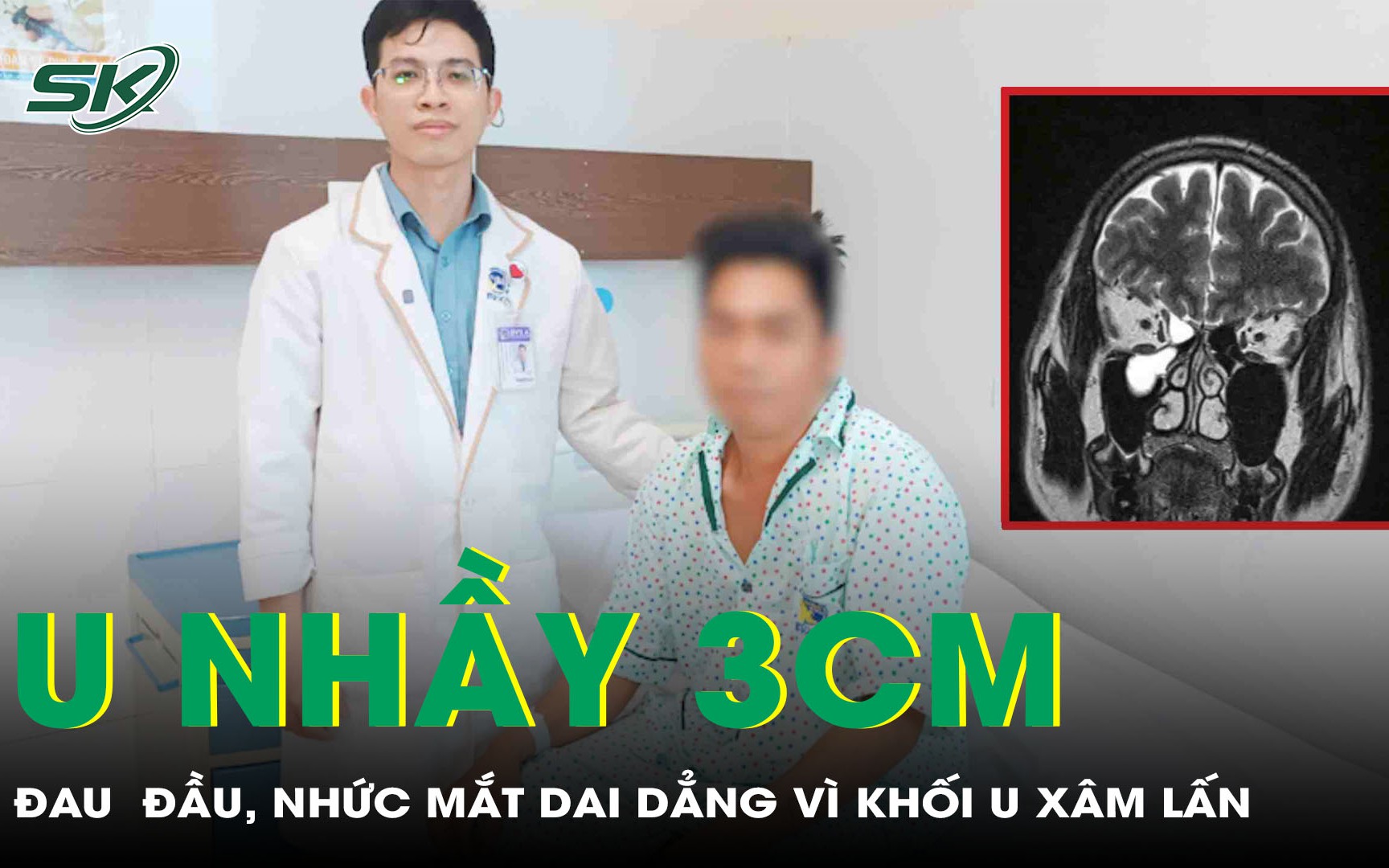 Phẫu thuật cắt u nhầy xoang hàm kích thước lớn xâm lấn sàn sọ hủy xương ổ mắt