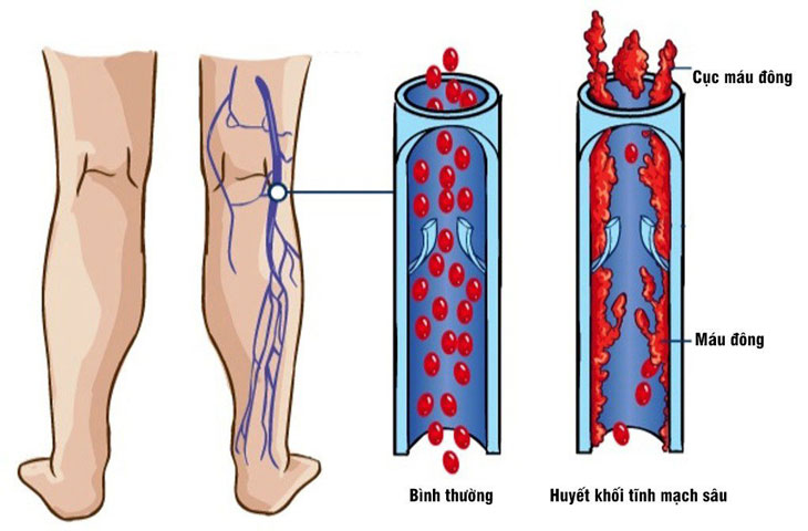 Bài tập co duỗi cổ chân ngăn ngừa cục máu đông- Ảnh 1. huyet-khoi-tinh-mach-sau-chi-duoi_8706