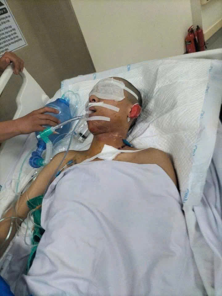 Sự sống mong manh của nam sinh lớp 12 bị sét đánh nguy kịch khi đi phụ mẹ ngoài đồng- Ảnh 1. Sự sống mong manh của nam sinh lớp 12 bị sét đánh nguy kịch khi đi phụ mẹ ngoài đồng- Ảnh 1.