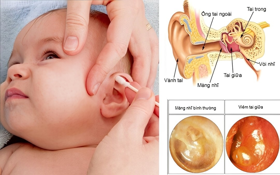 Trẻ dưới 2 tuổi bị viêm tai giữa cấp mủ: Cha mẹ cần làm gì để cải thiện nhanh triệu chứng?