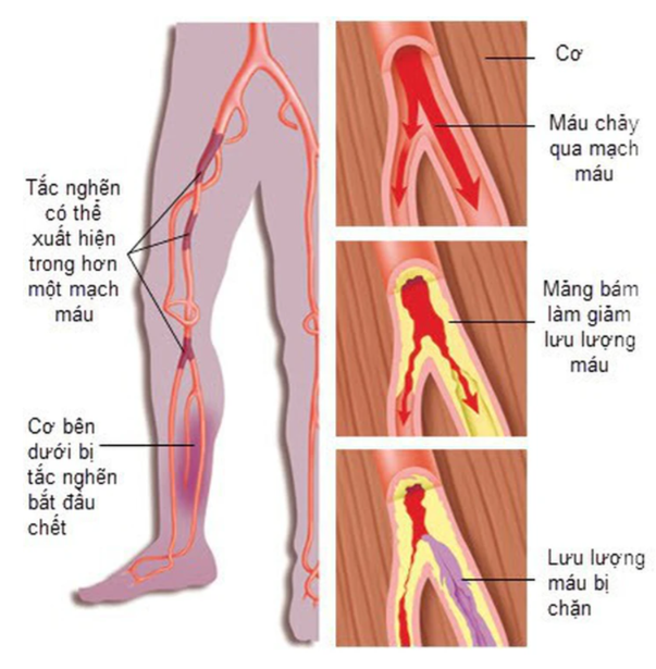 Xơ vữa động mạch ngoại biên: Nguyên nhân, triệu chứng, phòng bệnh và cách điều trị- Ảnh 2. Xơ vữa động mạch ngoại biên: Nguyên nhân, triệu chứng, phòng bệnh và cách điều trị- Ảnh 2.