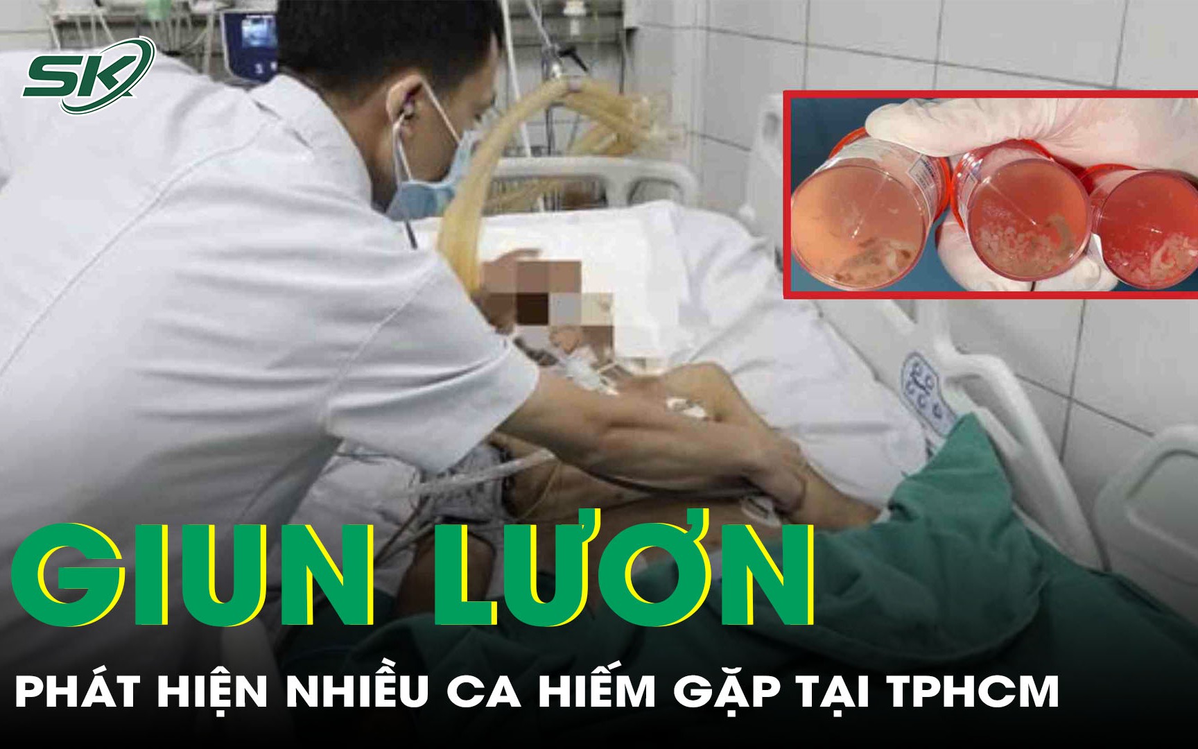 Thích ăn gỏi, rau sống dễ nhiễm giun đũa và cách phát hiện sớm bệnh này- Ảnh 2.