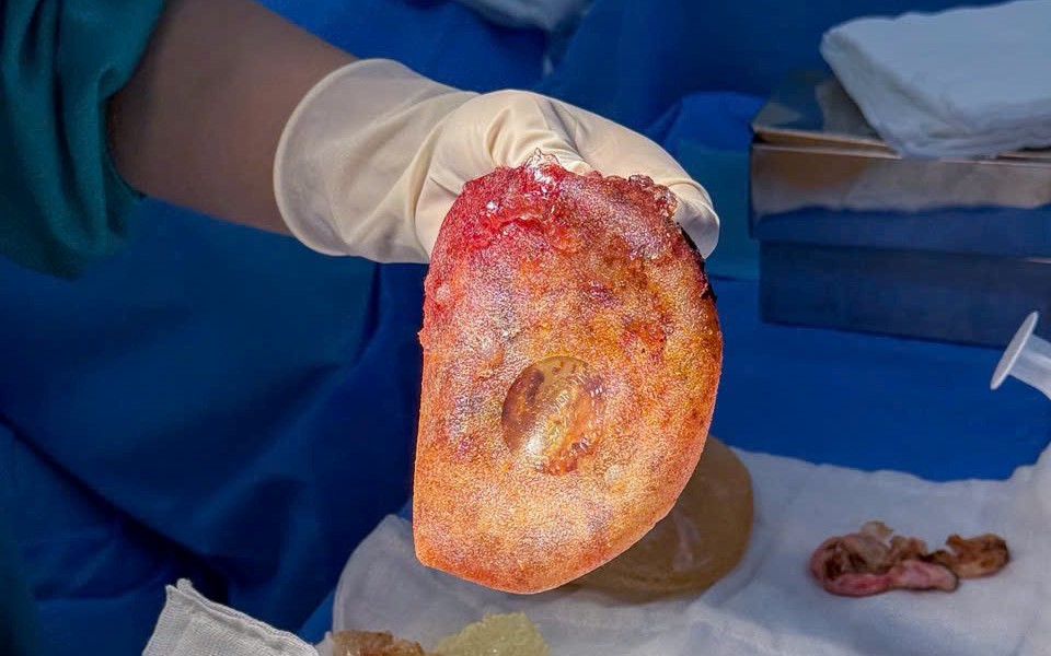 Điều trị co thắt bao xơ sau nâng ngực 1 3 17510095223721991783043 162 0 762 960 crop 1751009611298333548737