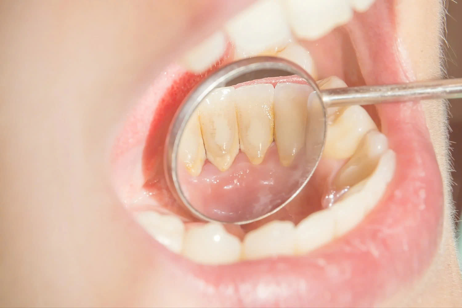 Cách nhận biết cao răng đang tích tụ- Ảnh 1. Cách nhận biết cao răng đang tích tụ- Ảnh 1.