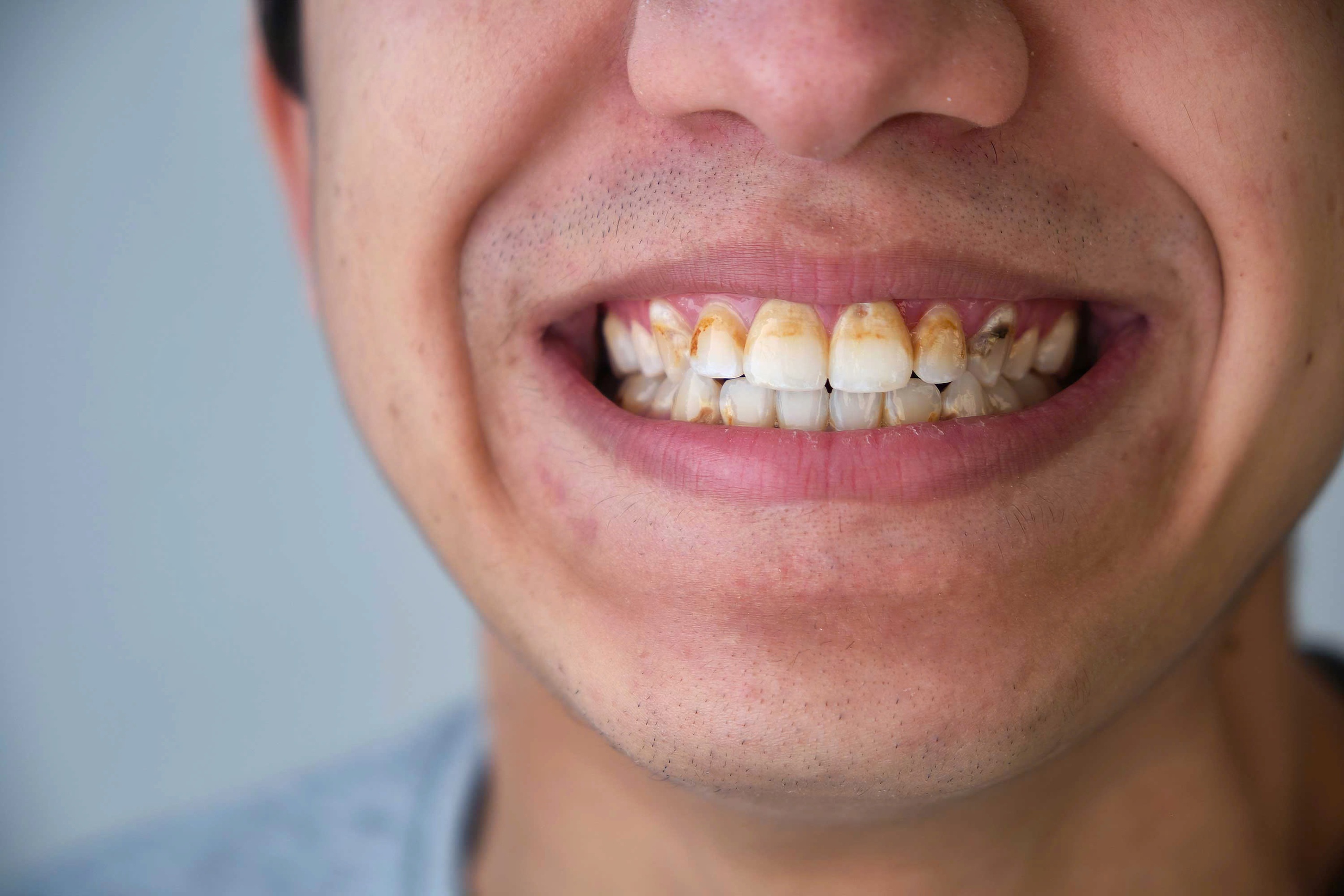 Cách nhận biết cao răng đang tích tụ- Ảnh 2. Cách nhận biết cao răng đang tích tụ- Ảnh 2.