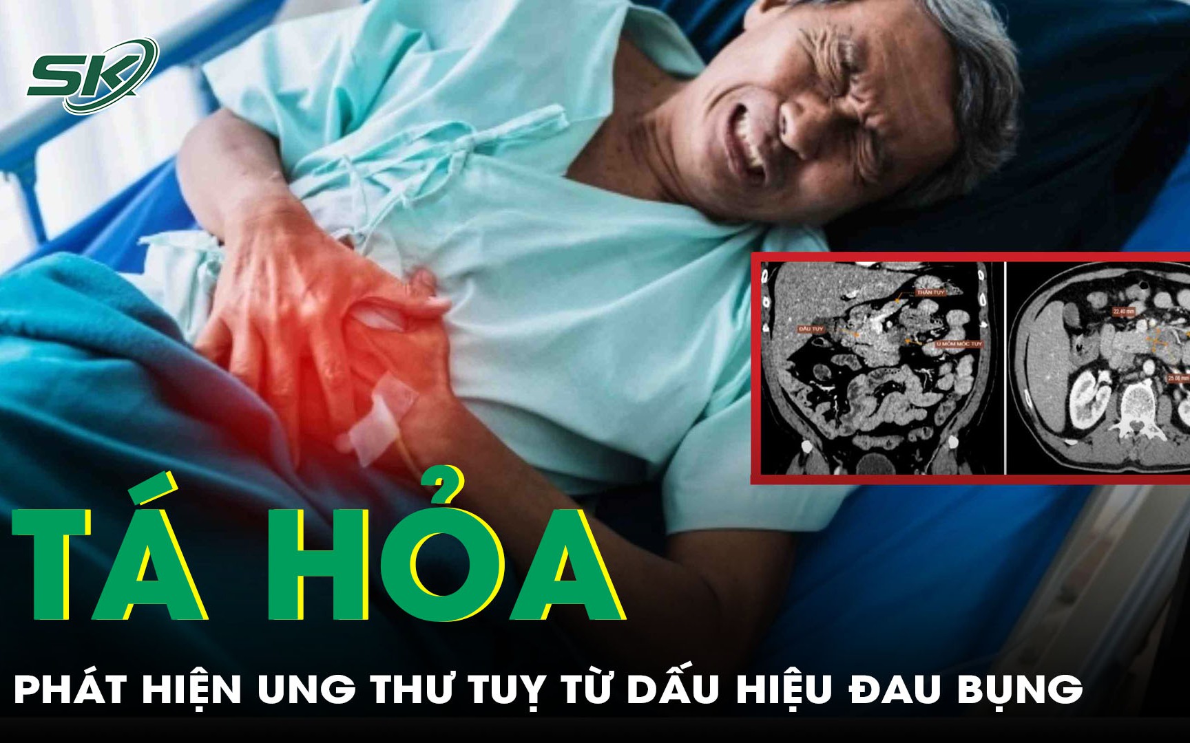 Tưởng đau bụng thông thường, bệnh nhân tá hoả phát hiện ung thư tụy giai đoạn cuối