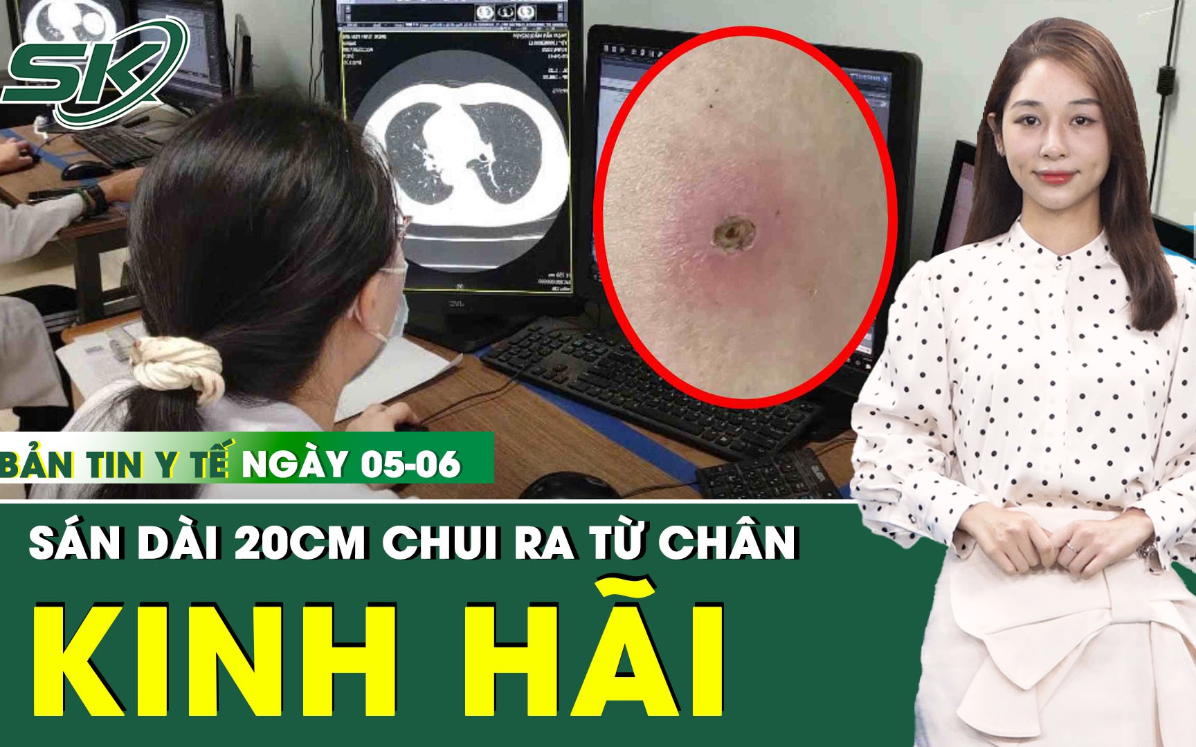 Bản tin Y tế 5/6: Kinh hãi giun sán chui ra từ chân 2 anh em do ăn món khoái khẩu  