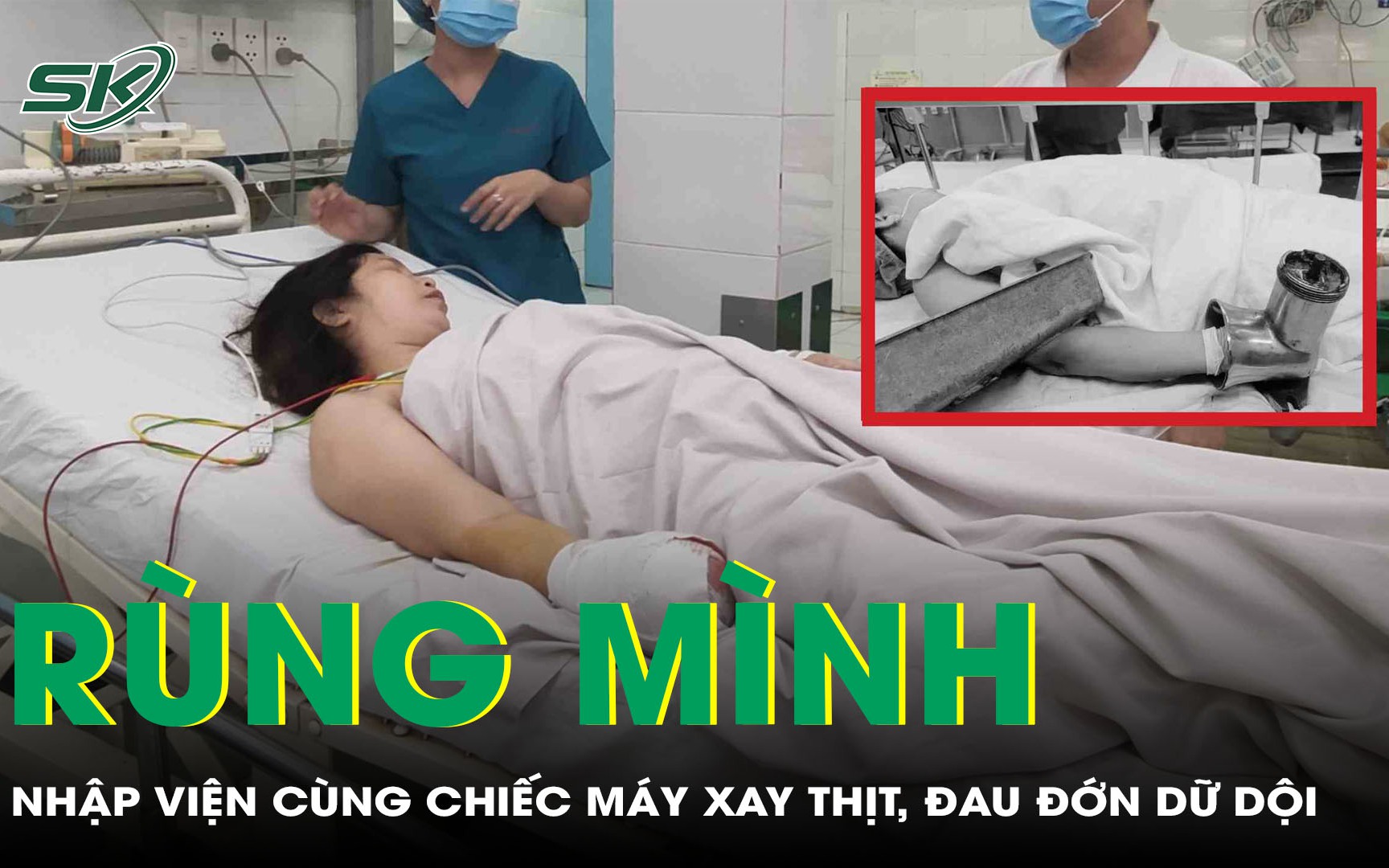 Rùng mình: Người phụ nữ nhập viện cùng chiếc máy xay thịt, đau đớn dữ dội 