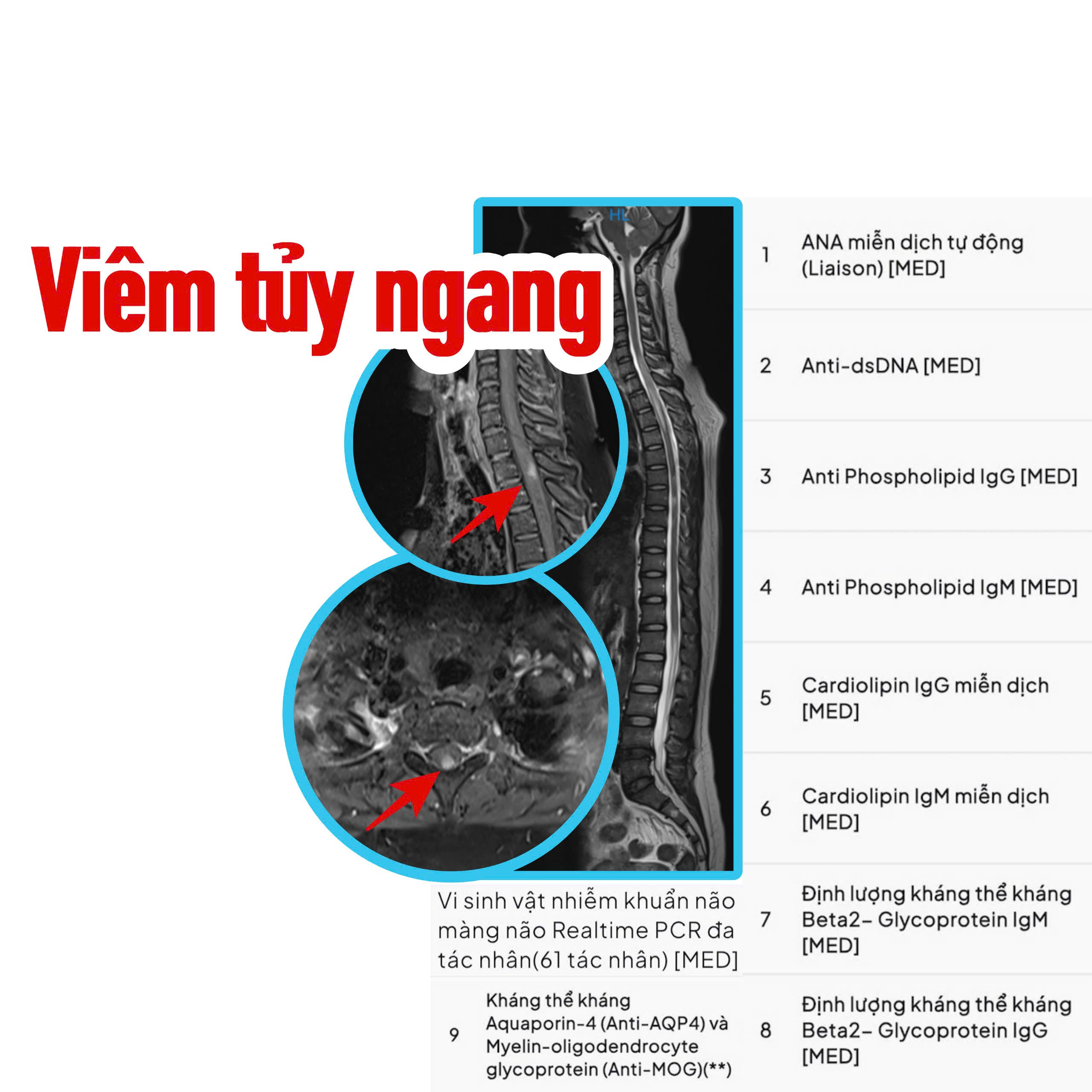 Viêm tủy ngang: Nguyên nhân, triệu chứng, chẩn đoán và cách điều trị- Ảnh 1. Viêm tủy ngang: Nguyên nhân, triệu chứng, chẩn đoán và cách điều trị- Ảnh 1.