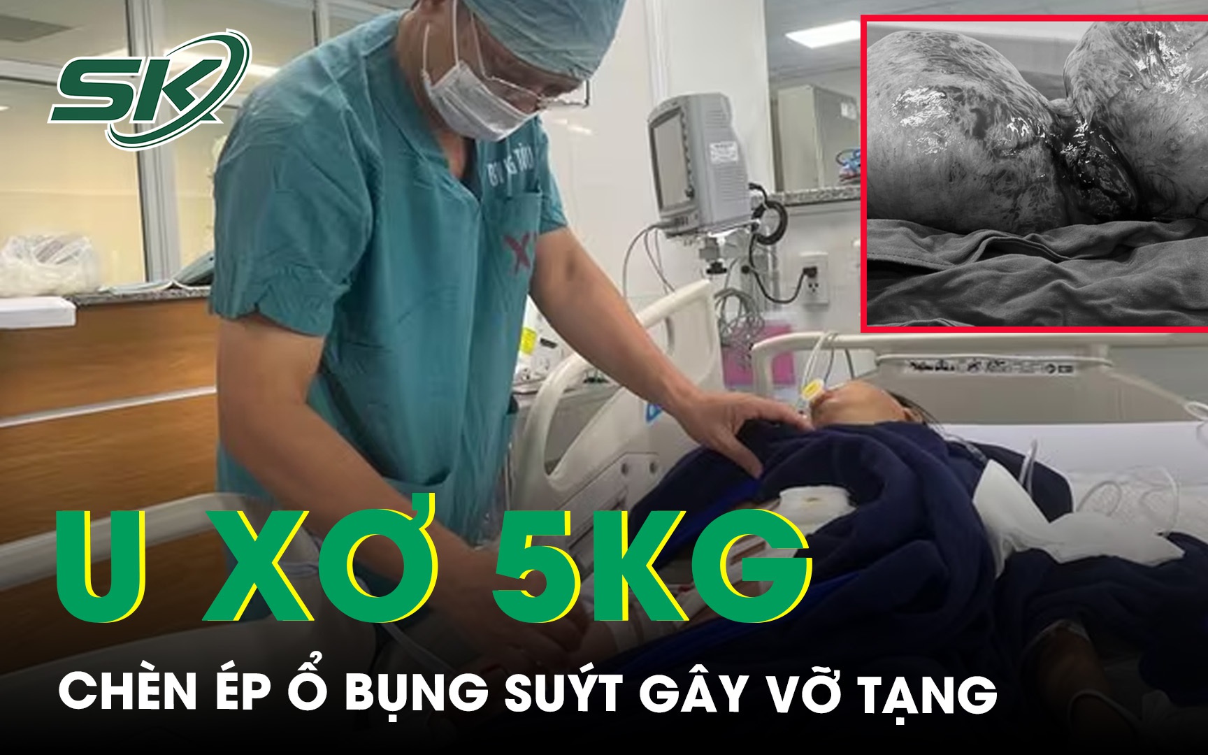 Cứu sống nữ bệnh nhân mang khối u xơ tử cung 5kg chèn ép suýt vỡ tạng
