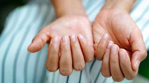Bổ sung vitamin và khoáng chất nào khi móng tay giòn, dễ gãy?- Ảnh 2. Móng tay giòn có phải là dấu hiệu thiếu vitamin hoặc khoáng chất không?