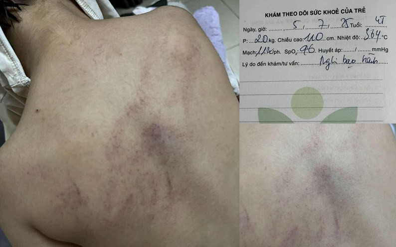 Cục Bà mẹ và Trẻ em lên tiếng về vụ trẻ bị bạo hành ở Hà Nội