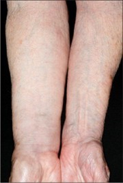 Cách kiểm soát tình trạng phù bạch huyết ở bệnh nhân ung thư vú- Ảnh 1. A close up of a person's hairy arm Description automatically generated with low confidence