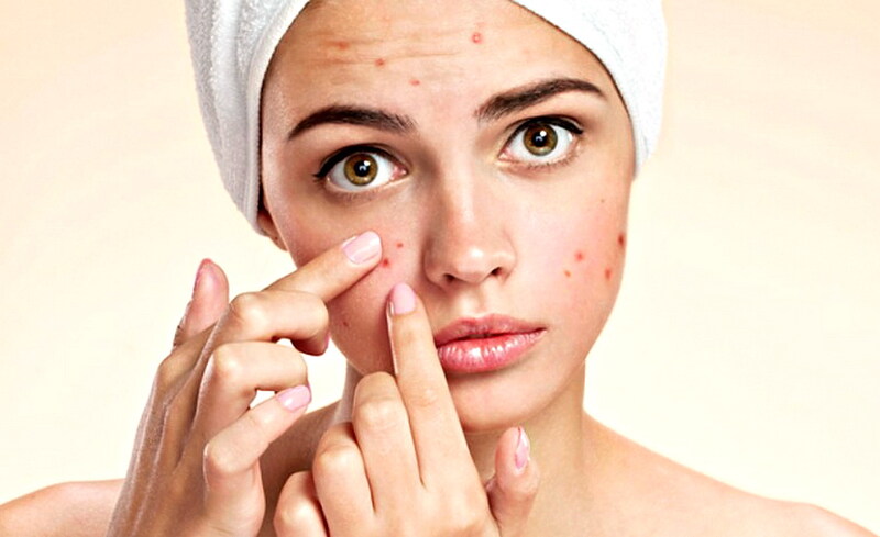 Cách xử lý mụn trứng cá, phục hồi làn da khỏe mạnh sau mụn- Ảnh 1.
