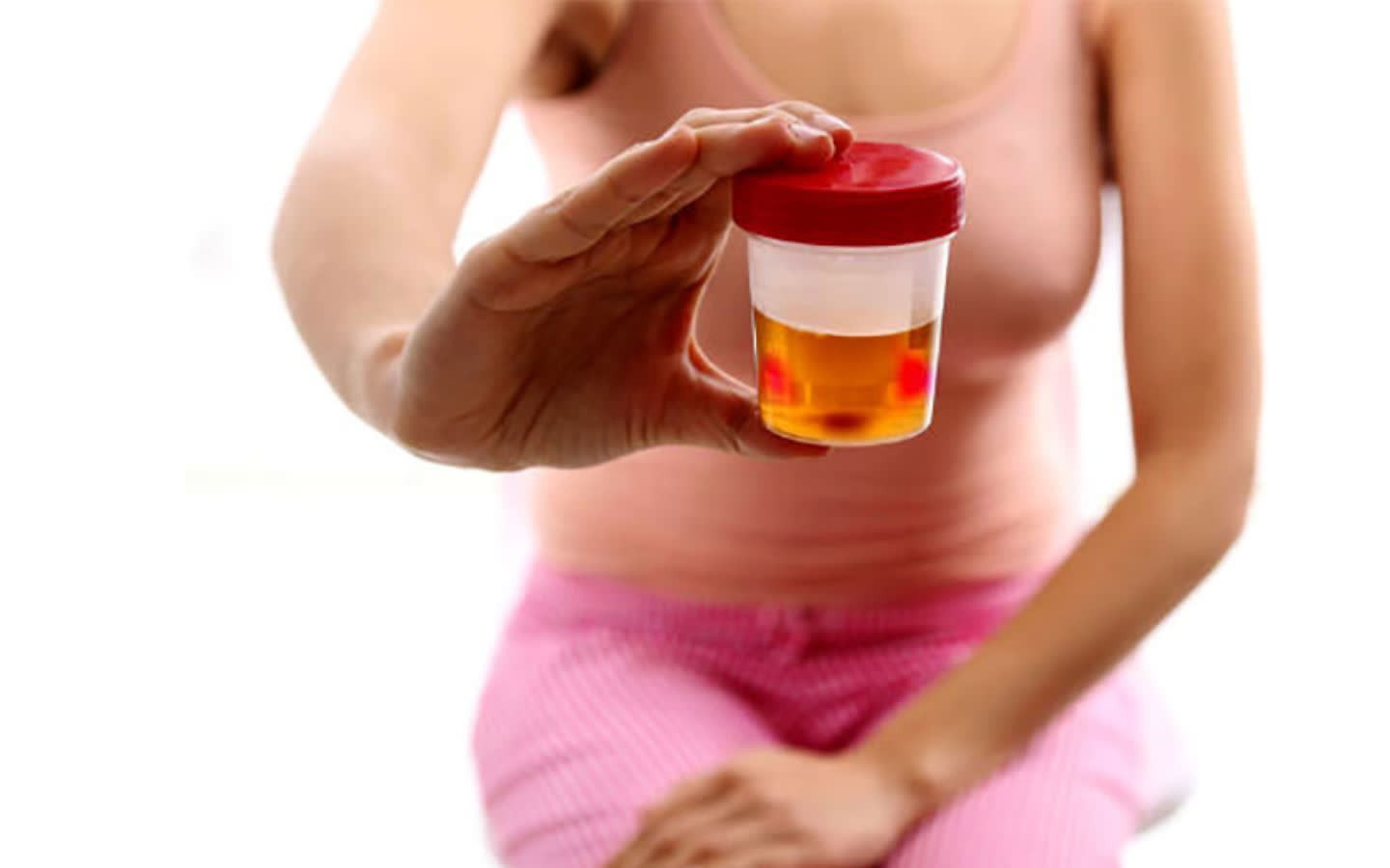 Tiểu ra máu có nguy hiểm không?- Ảnh 1. Tiểu ra máu cảnh báo bệnh gì, nguy hiểm không?