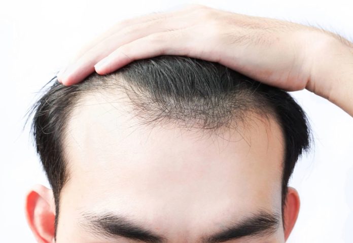 Dấu hiệu nhận biết sớm hói đầu và những lầm tưởng phổ biến- Ảnh 2. Dấu hiệu nhận biết sớm hói đầu và những lầm tưởng phổ biến- Ảnh 2.