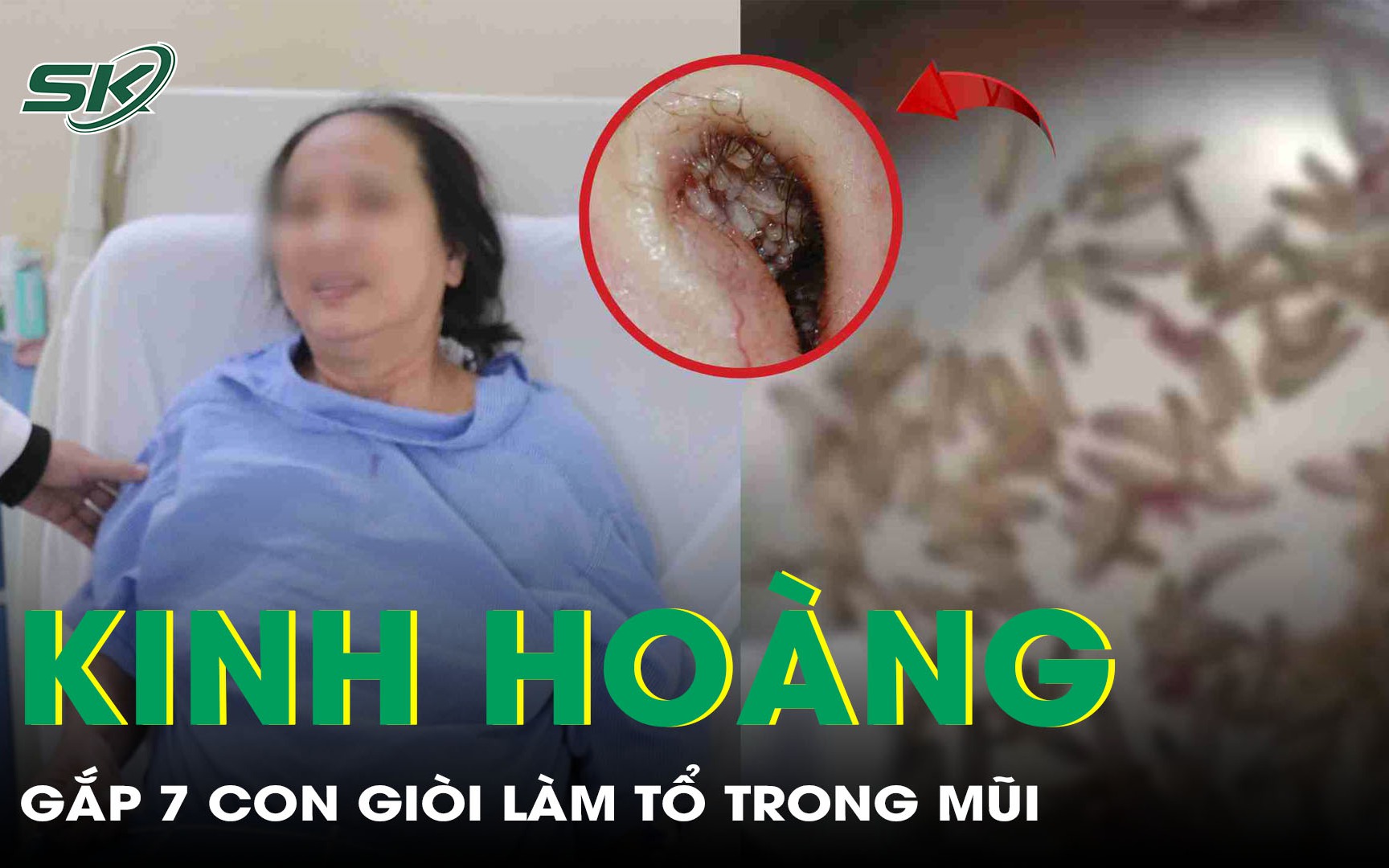 Ổ giòi làm tổ cùng dị vật sỏi trong hốc mũi khiến người phụ nữ nghẹt mũi, chảy máu liên tục