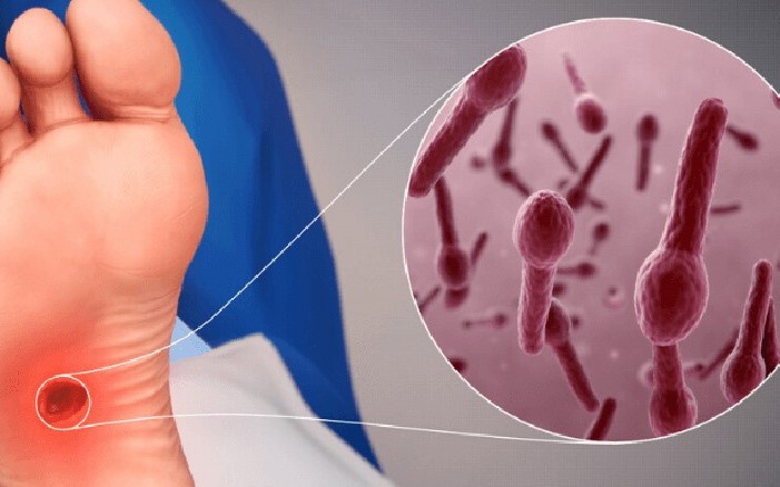 Chủ quan với vết thương nhỏ có thể mắc uốn ván nguy hiểm