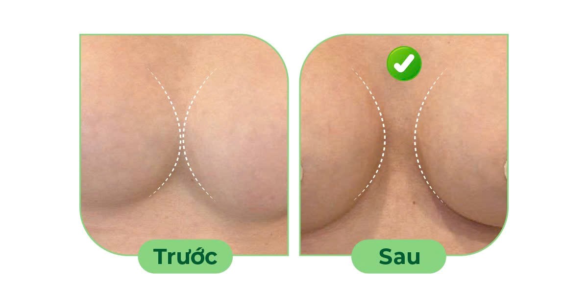 Điều trị ngực thông khe sau nâng ngực- Ảnh 2. Điều trị ngực thông khe sau nâng ngực- Ảnh 2.