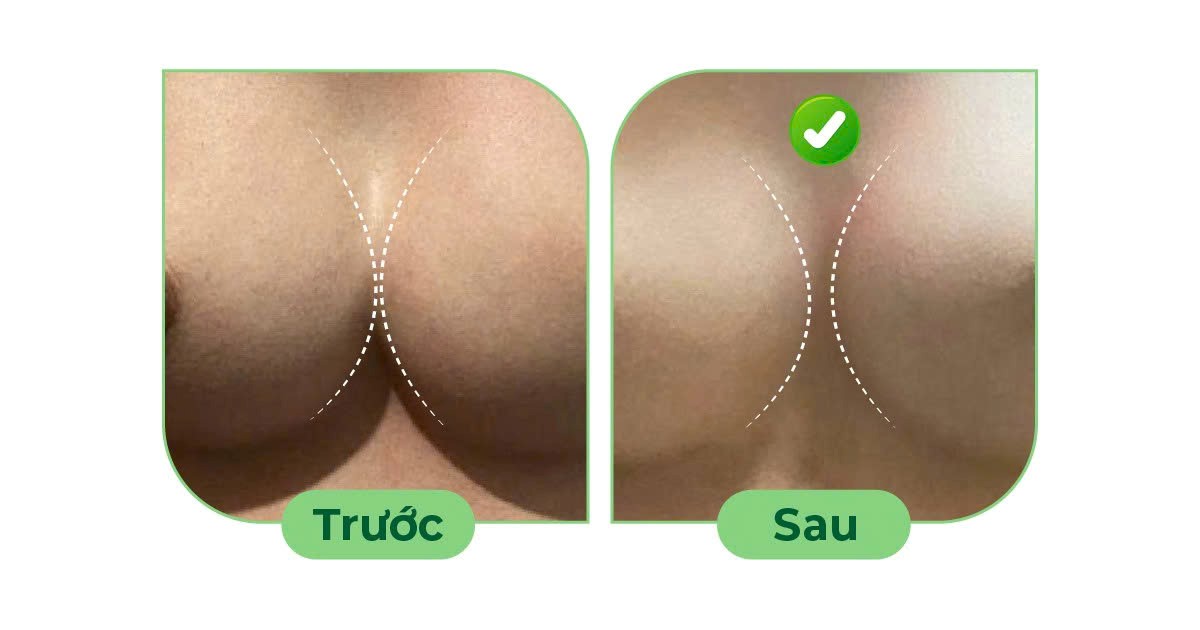 Điều trị ngực thông khe sau nâng ngực- Ảnh 3. Điều trị ngực thông khe sau nâng ngực- Ảnh 3.
