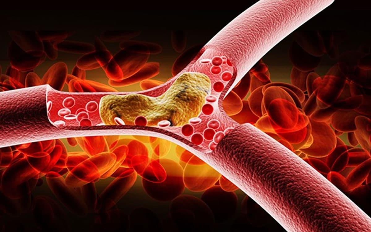 Tăng triglycerid máu: Hiểm họa tiềm ẩn và cách kiểm soát hiệu quả- Ảnh 3.
