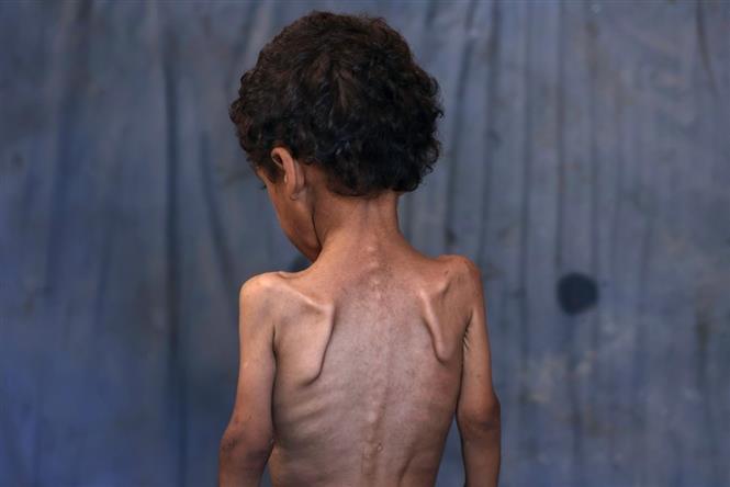Xung đột Hamas - Israel: Hàng chục nghìn người ở Gaza suy dinh dưỡng nghiêm trọng- Ảnh 2. Xung đột Hamas - Israel: Hàng chục nghìn người ở Gaza suy dinh dưỡng nghiêm trọng- Ảnh 2.