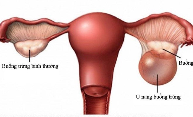 U nang buồng trứng khi nào cần phẫu thuật?- Ảnh 1. U nang buồng trứng khi nào cần phẫu thuật?- Ảnh 1.