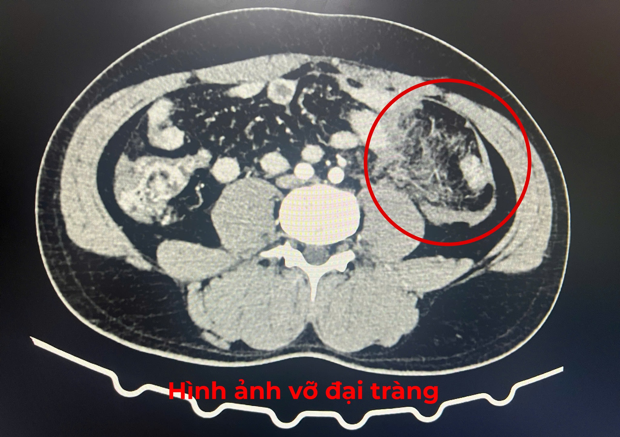 Bác sĩ tuyến đảo xuyên đêm giành sự sống cho bệnh nhân sốc đa chấn thương- Ảnh 2. Bác sĩ tuyến đảo xuyên đêm giành sự sống cho bệnh nhân sốc đa chấn thương- Ảnh 2.