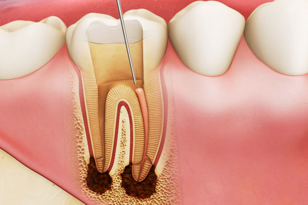 Điều trị lấy tuỷ buồng cho răng viêm tuỷ có tổn thương quanh chóp: Cơ hội giữ lại tuỷ sống cho răng- Ảnh 1.