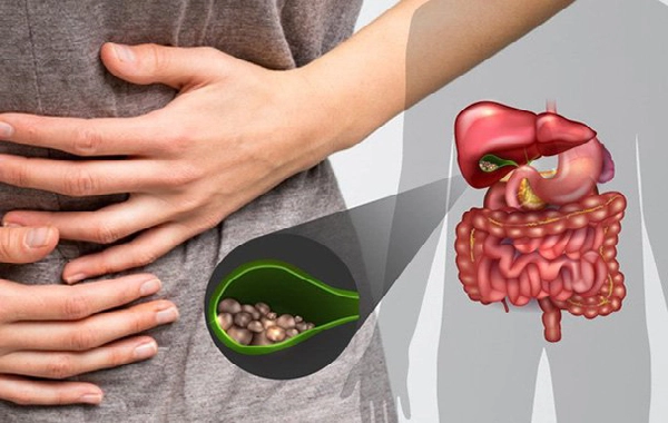 Sỏi mật gây biến chứng gì?- Ảnh 1. Sỏi mật gây biến chứng gì?- Ảnh 1.