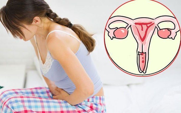 5 dấu hiệu nghi ngờ ung thư cổ tử cung chị em cần biết