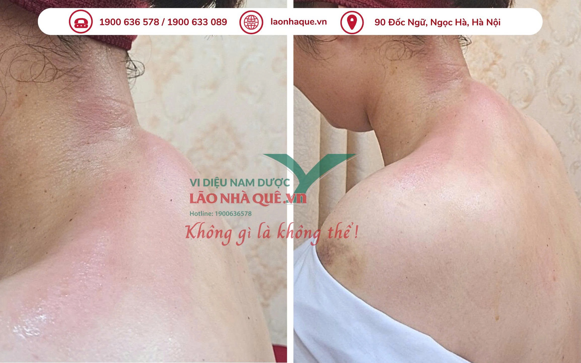 Đau vai gáy dai dẳng - cảnh báo thoái hóa đốt sống cổ từ thói quen xấu