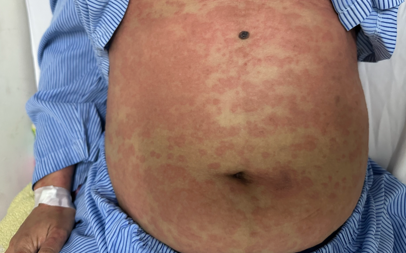 Một phụ nữ nguy kịch sau khi dùng thuốc giảm cân thải độc, collagen không rõ nguồn gốc