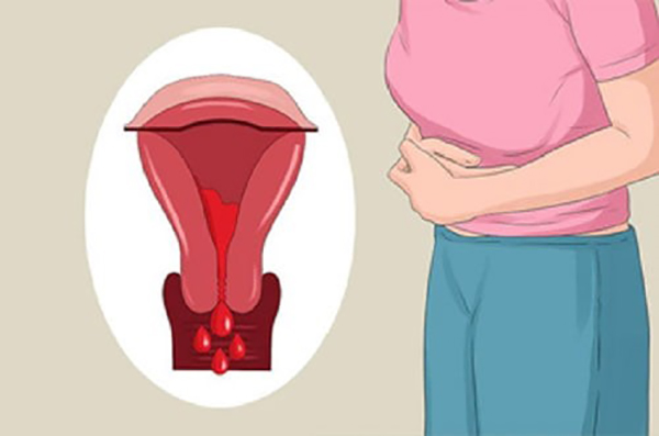U xơ tử cung dưới niêm mạc là gì và ảnh hưởng sức khỏe thế nào?- Ảnh 2.