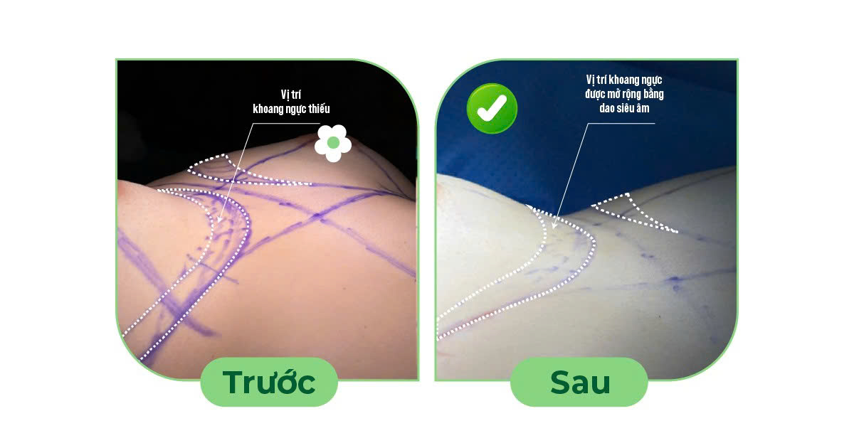 Điều trị ngực cứng sau nâng ngực- Ảnh 2. Điều trị ngực cứng sau nâng ngực- Ảnh 2.