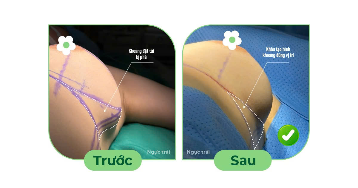 Điều trị ngực cứng sau nâng ngực- Ảnh 3. Điều trị ngực cứng sau nâng ngực- Ảnh 3.