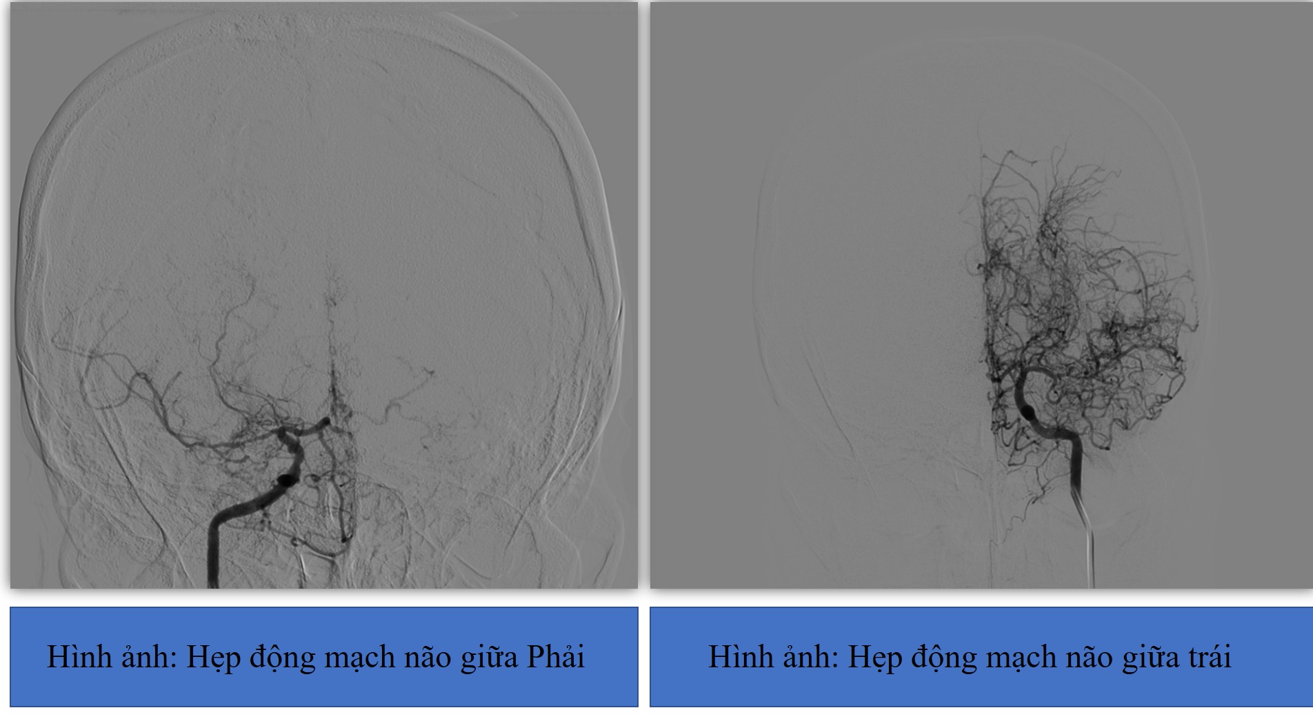 Đau đầu, khó nói, người phụ nữ bị nhồi máu não do căn bệnh hiếm gặp- Ảnh 1.