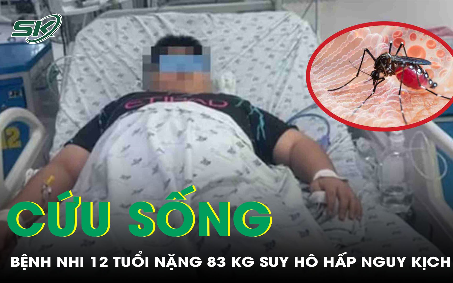 Cứu sống bệnh nhi 12 tuổi béo phì sốc sốt xuất huyết, biến chứng suy hô hấp nặng 