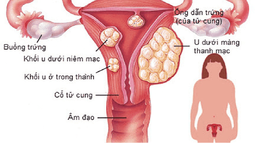 Dấu hiệu điển hình của u xơ tử cung- Ảnh 1.