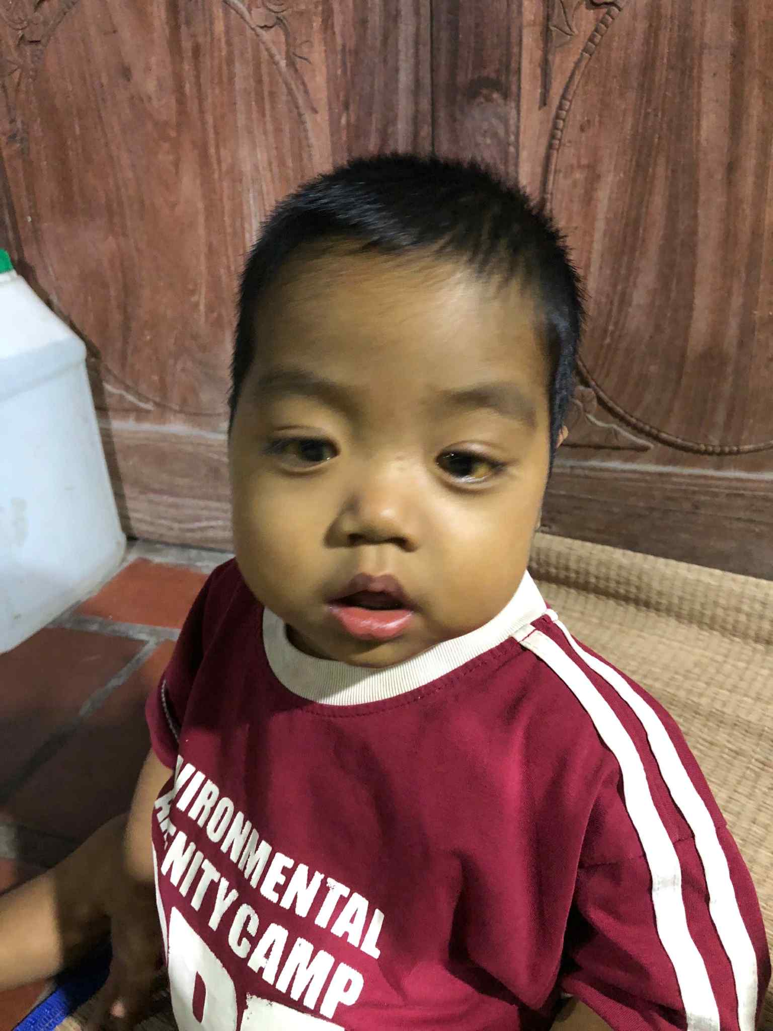 Sự sống mong manh của bé trai 21 tháng tuổi bị teo mật bẩm sinh, xơ gan- Ảnh 1. Sự sống mong manh của bé trai 21 tháng tuổi bị teo mật bẩm sinh, xơ gan- Ảnh 1.