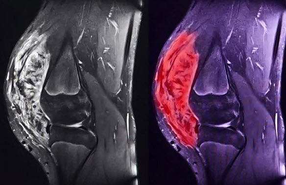 Sarcoma cơ vân ở trẻ em tiến triển nhanh, khó phát hiện sớm- Ảnh 2. Sarcoma cơ vân ở trẻ em tiến triển nhanh, khó phát hiện sớm- Ảnh 2.