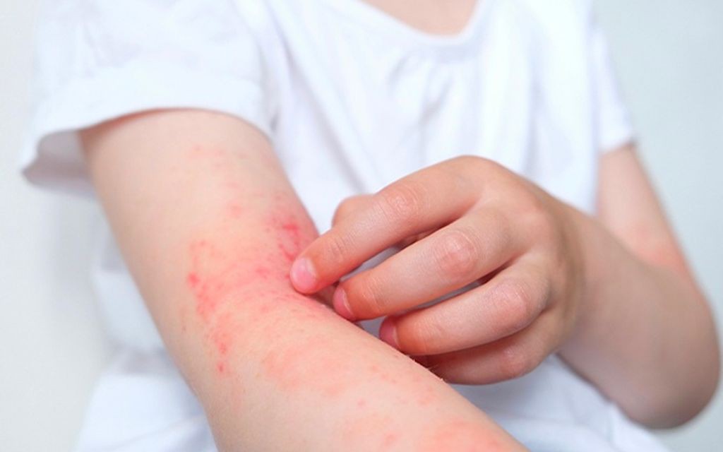 Bài thuốc điều trị viêm da cơ địa