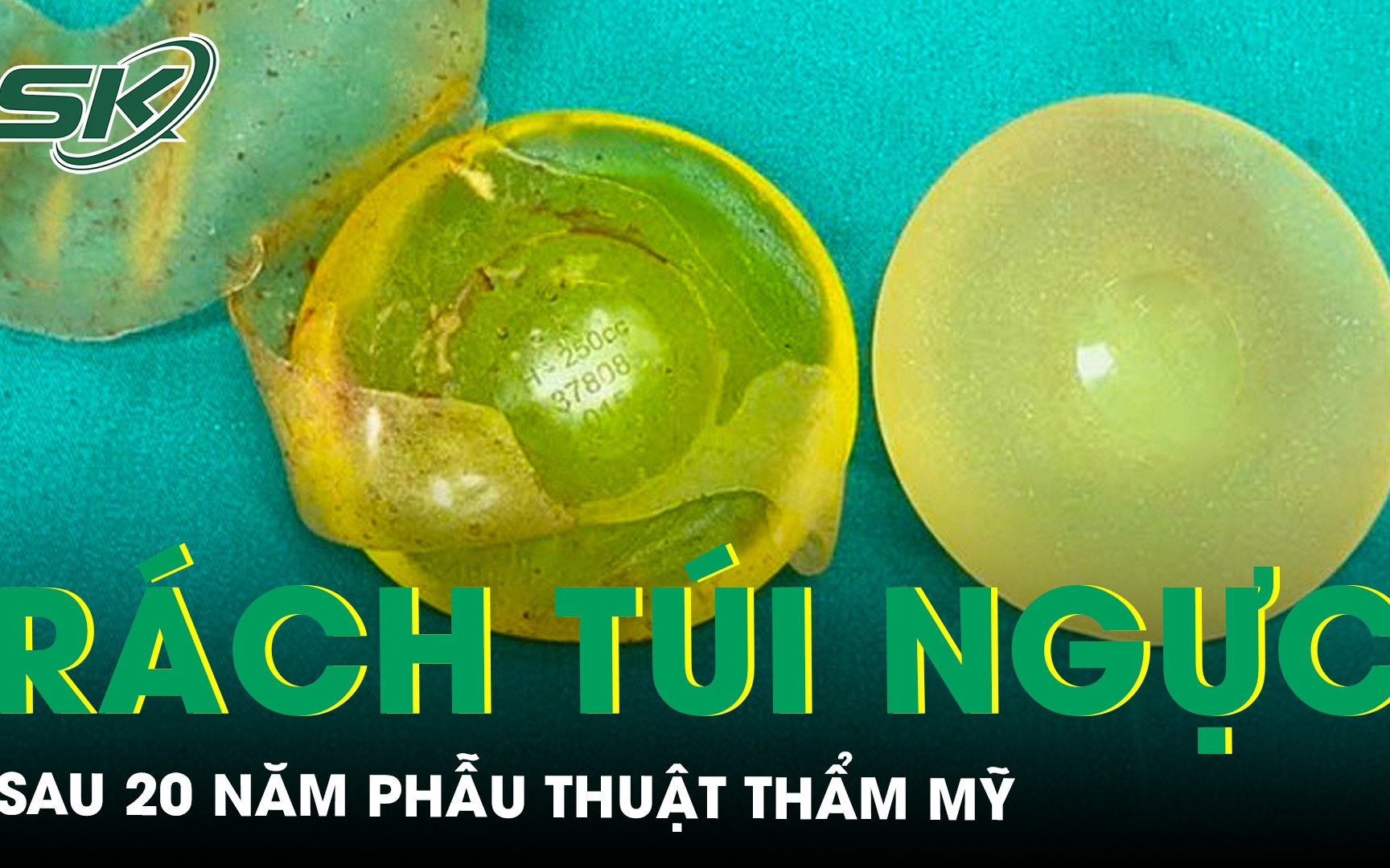 Rách túi ngực sau 20 năm phẫu thuật thẩm mỹ