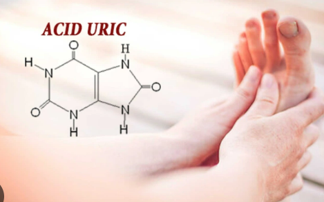 Acid uric cao gây ra những vấn đề sức khỏe nghiêm trọng nào?