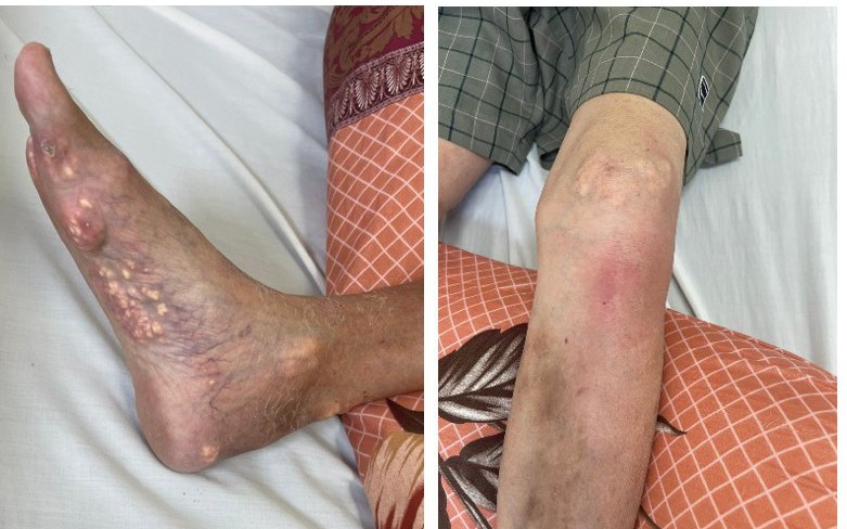 Tự ý mua thuốc của thầy lang để chữa gout, bệnh nhân bị suy tuyến thượng thận
