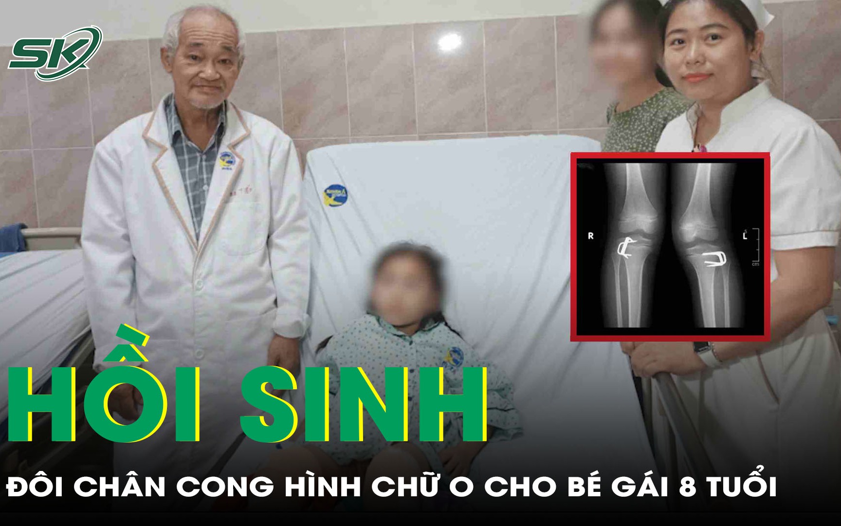 Hồi sinh đôi chân vòng kiềng hình chữ O cho bé gái 8 tuổi