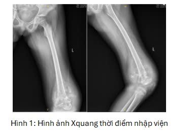 Xúc động trước gia cảnh khó khăn của bệnh nhi ung thư xương, bác sĩ quyết tâm giữ lại đôi chân cho bé- Ảnh 1. Xúc động trước gia cảnh khó khăn của bệnh nhi ung thư xương, bác sĩ quyết tâm giữ lại đôi chân cho bé- Ảnh 1.