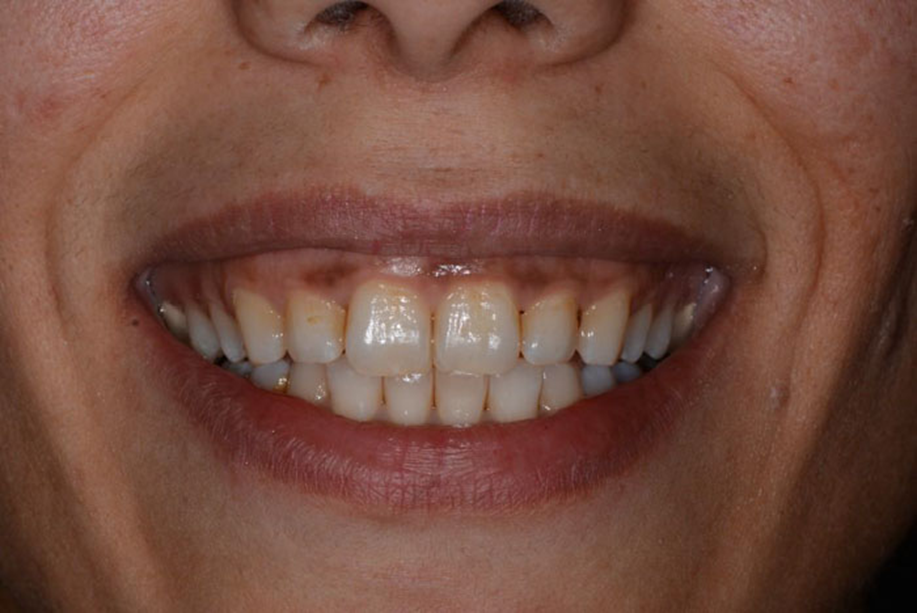 Muốn cười đẹp đừng bỏ quên nướu: Chăm đúng cách, nướu sẽ hồng!- Ảnh 1.