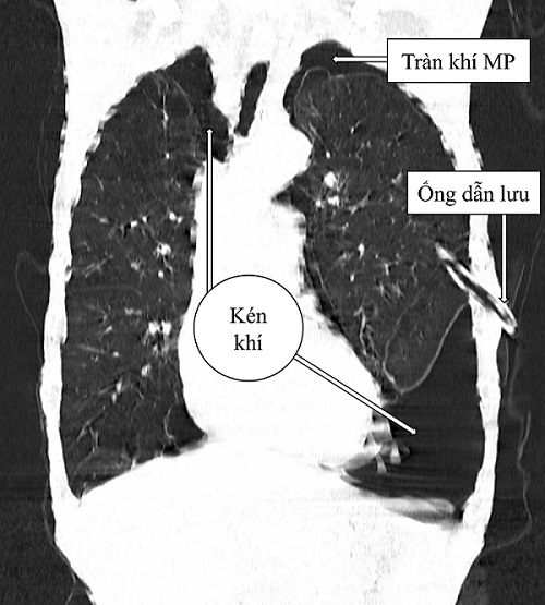 Đột ngột khó thở cảnh giác với kén khí phổi- Ảnh 1.