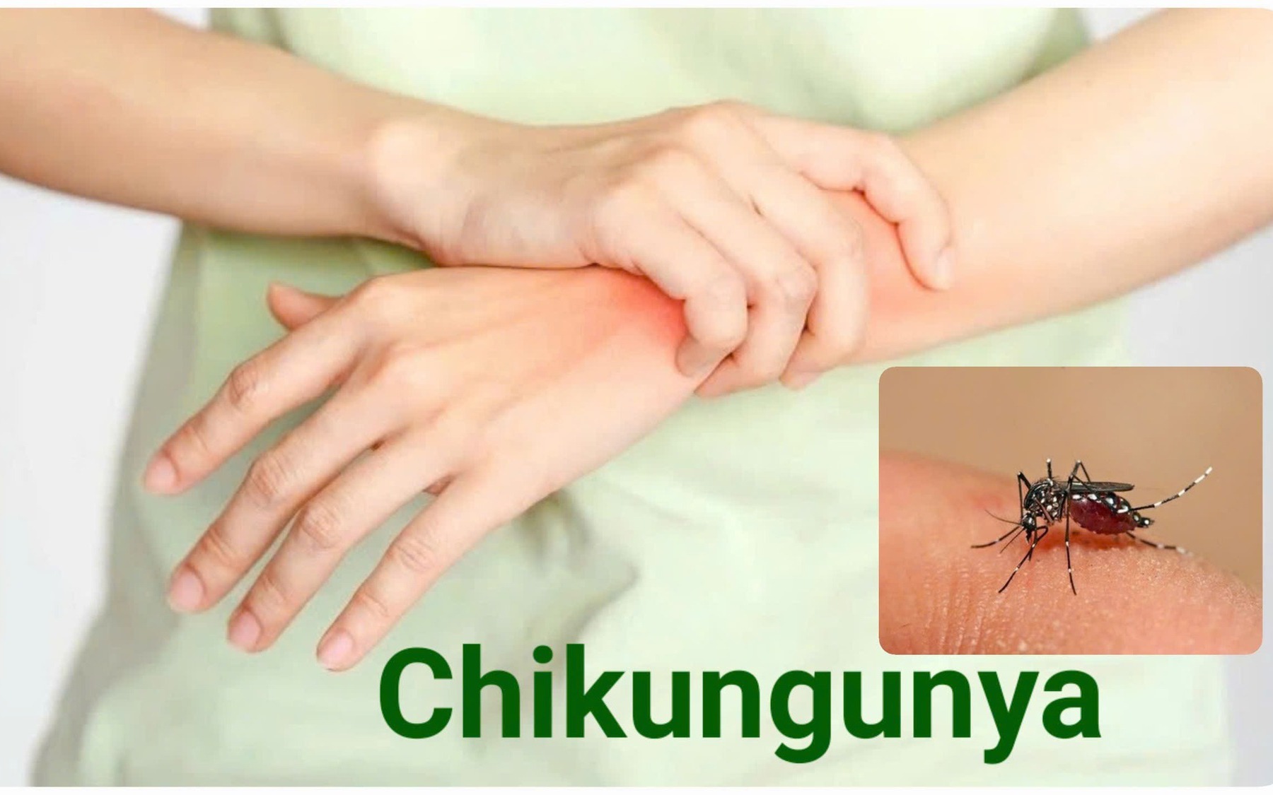 Bệnh Chikungunya: Nguyên nhân, triệu chứng, cách điều trị và phòng bệnh